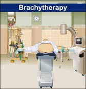 Brachytherapy Illustration