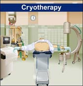 Cryotherapy Illustration